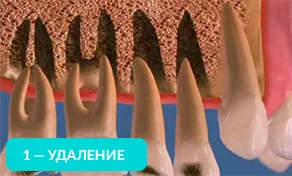 Удаление